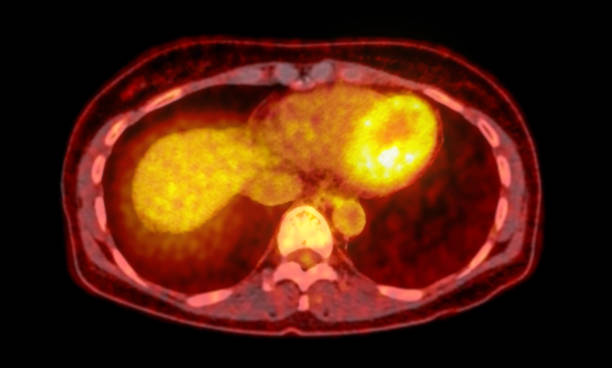 istock A PET-CT scan image is a diagnostic visualization combining Positron Emission Tomography (PET) and Computed Tomography (CT) for Helps in finding cancer recurrence. 2083825102