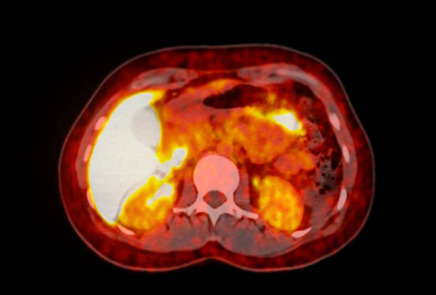 istock A PET-CT scan image is a diagnostic visualization combining Positron Emission Tomography (PET) and Computed Tomography (CT) for Helps in finding cancer recurrence. 2083825623