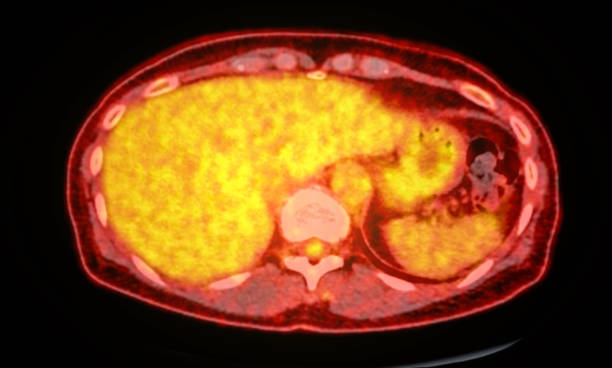 istock A PET-CT scan image is a diagnostic visualization combining Positron Emission Tomography (PET) and Computed Tomography (CT) for Helps in finding cancer recurrence. 2083826177