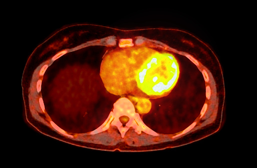 A PET-CT scan image is a diagnostic visualization combining Positron Emission Tomography (PET) and Computed Tomography (CT) for Helps in finding cancer recurrence.