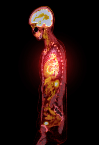 A PET-CT scan image is a diagnostic visualization combining Positron Emission Tomography (PET) and Computed Tomography (CT) for Helps in finding cancer recurrence.