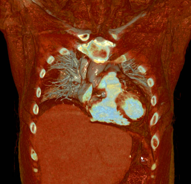 istock CTA thoracic aorta 3D rendering offers detailed visualization, providing clear insights into aortic anatomy, pathology, and surrounding structures for accurate diagnosis and treatment planning. 2083829955