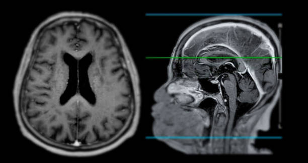 mri  brain scan  sagittal plane for detect  brain  diseases sush as stroke disease, brain tumors and infections. - mri scan brain alzheimers disease medical scan fotografías e imágenes de stock