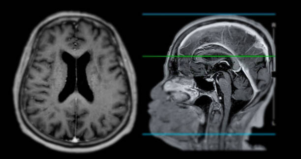 mri  brain scan  sagittal plane for detect  brain  diseases sush as stroke disease, brain tumors and infections. - brain mri scan alzheimers disease medical scan imagens e fotografias de stock