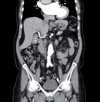 CT scan of  whole abdomen with injection contrast  media in coronal view.