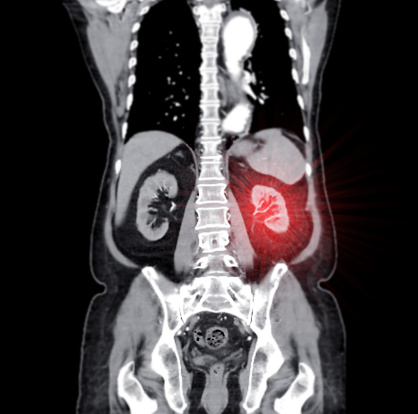CT scan of  whole abdomen with injection contrast  media in coronal view.