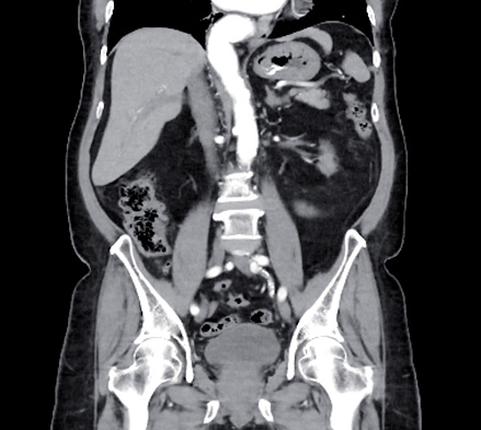 CT scan of  whole abdomen with injection contrast  media in coronal view.