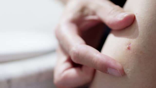 hand removing a pus pimple by peeling it off with the fingers.