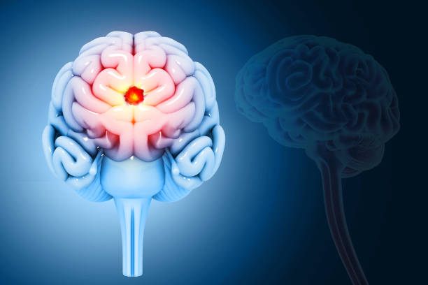 istock Brain tumor or barin cancer. 3d illustration 2086172031