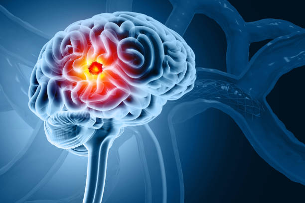 istock Brain tumor or barin cancer. 3d illustration 2086172040