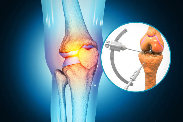 istock Human knee replacement surgery. Knee joint treatment. Knee injury. 3d illustration 2086196384