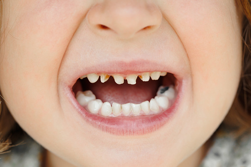 Close-up of unhealthy milk teeth.