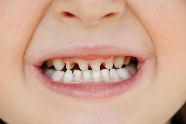 istock Close-up of unhealthy milk teeth. 2086238114