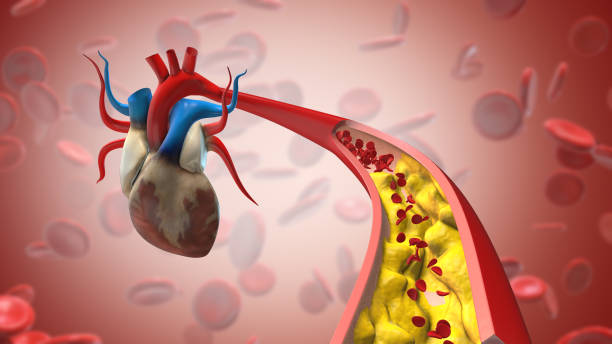 istock Cholesterol plaque in artery blocking blood flow 2088945072