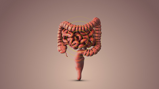 An intestinal disorder causing pain in the stomach, diarrhea, constipation, and change in the appearance of stool.The cause of irritable bowel syndrome is not well understood. A diagnosis is often made based on symptoms. It is the most common functional disorder.Symptoms include abdominal pain, bloating, diarrhea and constipation.