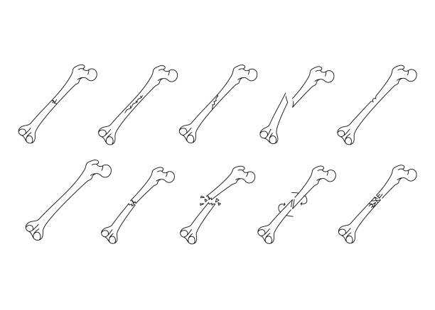 Bone fracture line icons set. Vector isolated element. Bone fracture line icons set. Vector isolated element. Editable stroke. femur bone anatomy drawing stock illustrations