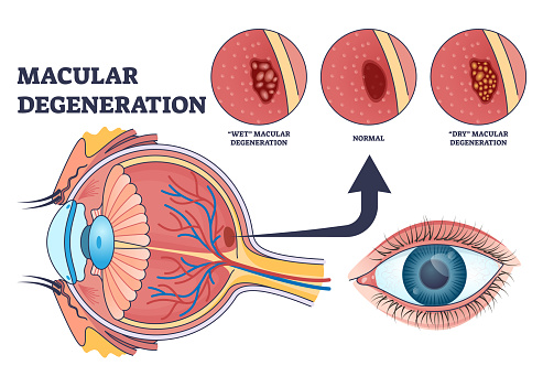 Macular degeneration as eye illness and eyesight problem outline diagram. Labeled educational scheme with central vision loss disease with wet or dry types vector illustration. Medical retina health.