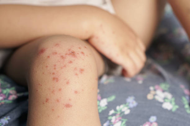 close up view of child's knee infected with hand feet and mouth disease or hfmd originating from enterovirus or coxsackie virus, red harsh on the skin. close up view zoom shot. - chickenpox skin condition baby illness stock-fotos und bilder