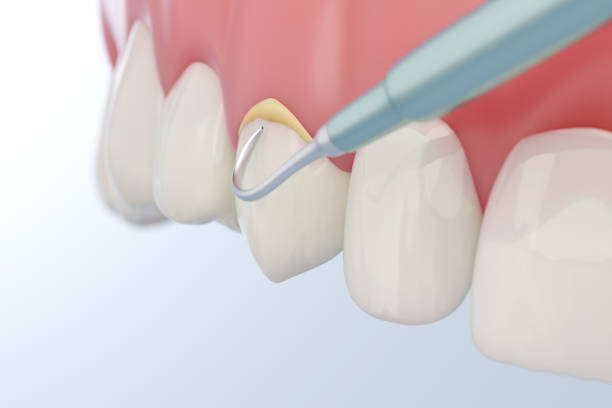 istock Dental tartar or calculus removal 2095499564