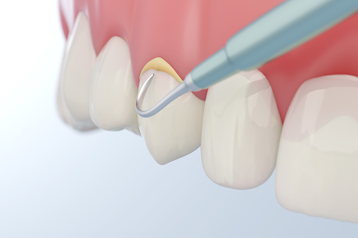 Dental tartar or calculus removal, 3D rendering.