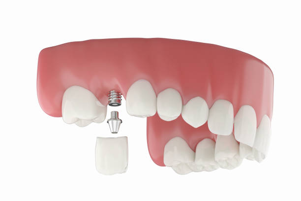 istock Dental implant at molar teeth 2095499570