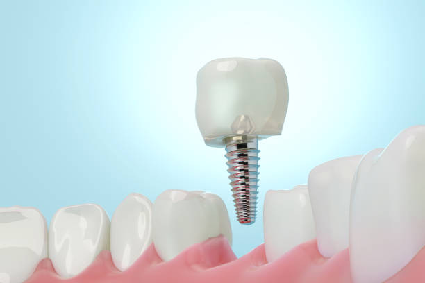 istock Dentistry dental implant 2095500087