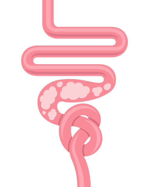 Gases in the intestine. Human Small Intestine. Intestinal obstruction. Gases in the intestine. Colitis. Gut constipation icon. Abdominal, bloating vector. Stomach. Gastroenterology for medical design. Healthcare. Stomach set icon for medical design. stomach knot stock illustrations