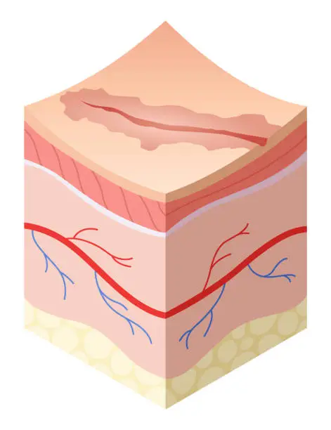 Vector illustration of Skincare medical concept. Problems in cross-section of human skin horizontal layers structure. Anatomy illustrative model unhealthy layer of skin