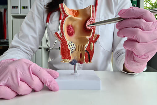 Anatomical model of the rectum, examined by a doctor. Methods for examining rectum