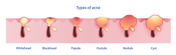 Types of acne vector on white background. Formation of noninflammatory acne, whitehead, blackhead, inflammatory acne, papule, pustule, nodule and cyst. Skin care and beauty concept illustration.