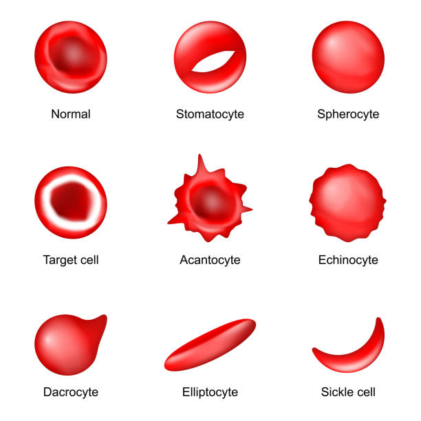 ilustraciones, imágenes clip art, dibujos animados e iconos de stock de forma de los glóbulos rojos. enfermedades de la sangre - sickle cell anemia red blood cell blood cell anemia