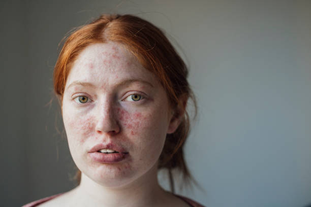 istock Young Female Adult With Behcet's 2099408915