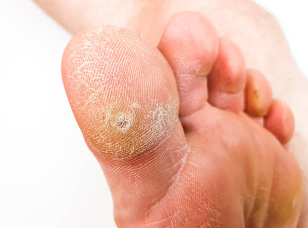 istock A wart on my toe. HPV plantar wart. 2101287994