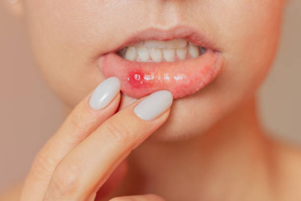 istock A young woman suffering from stomatitis pulls back her lower lip with both fingers, shows an ulcer of stomatitis in the acute stage on the mucous membrane of the mouth. Oral problems 2102258597
