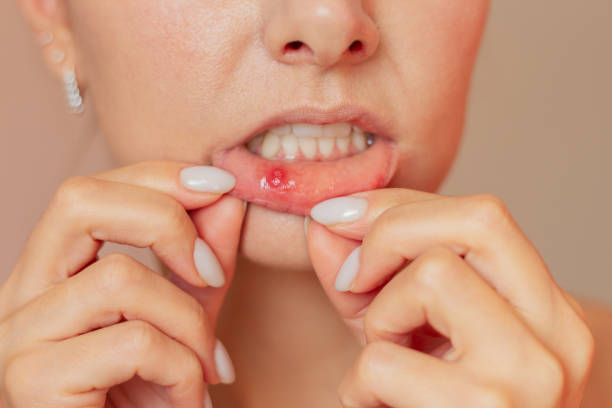 istock A young woman suffering from stomatitis. She pulls back her lower lip with both hands, shows an ulcer of stomatitis in the acute stage on the mucous membrane of the mouth. 2102262345