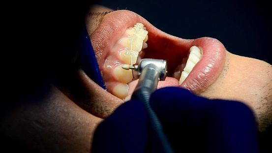 Professional dentist performing dental procedure to repair decayed tooth using drill and filling equipment in oral care clinic