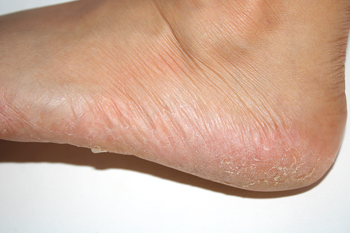 Picture of skin on the feet peeling from excessive sweating and fungus on the heels.