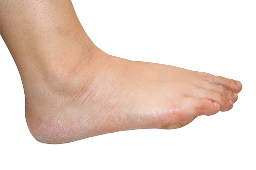 Two feet with bunions on the side of each big toe. One big toe has a bad ingrown nail. On white background.