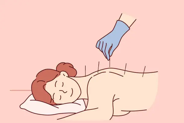 Vector illustration of Acupuncture procedure from traditional chinese medicine for woman lying at reception in SPA center