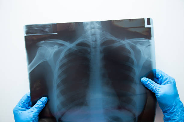A chest xray film of a patient with pneumonia or pneumonitis.  The patient has alveolar infiltration in the left middle lungs. Pulmonary tuberculosis is also considered.