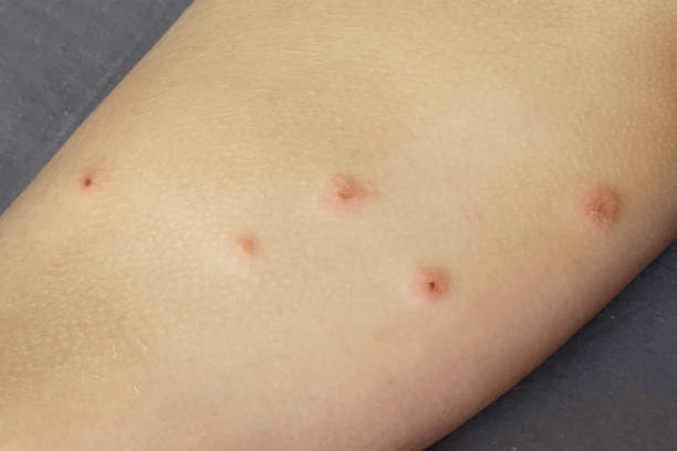 Bedbug bites. Body with skin problem. Infectious disease. Allergy, dermatitis, virus or bacterial infection. Dermatology,  medicine and health care concept.