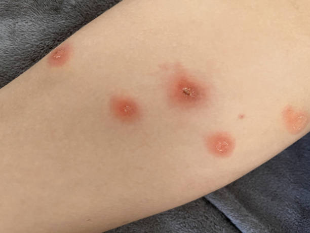 istock Human leg closeup.  Body with skin problem. Infectious disease. Allergy, dermatitis, virus or bacterial infection. Dermatology,  medicine and health care concept. 2106232192