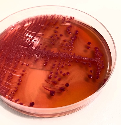 stx2a is a subtype of Shiga toxin-producing E. coli (STEC) linked to Hemolytic Uremic Syndrome (HUS), a severe condition impacting kidney function and blood clotting. STEC poses a significant risk of foodborne illness and can spread within communities including family members.