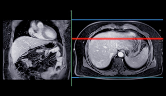 MRI of the upper abdomen  is a non-invasive imaging technique providing detailed visuals of organs like the liver, pancreas, and kidneys in case normal study.