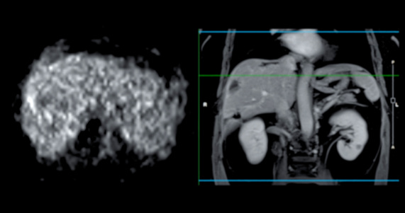 Ultrasound image of newborn right kidney in sagittal plane.