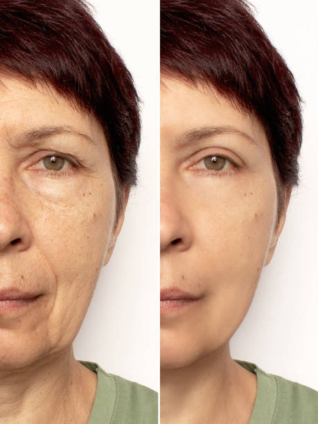istock Close-up of an elderly woman's face before and after a facelift 2109713725