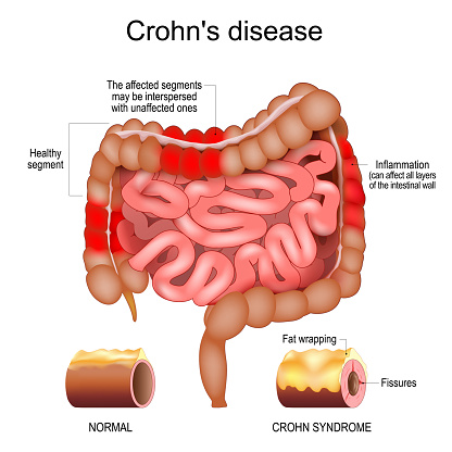 Crohn disease. Human large and small intestine with Healthy segments and Inflammation that affect  layers of the intestinal wall. The affected segments interspersed with unaffected ones. Close-up of a cross section of a intestinal wall with Fat wrapping and Fissures. Inflammatory bowel disease. vector illustration