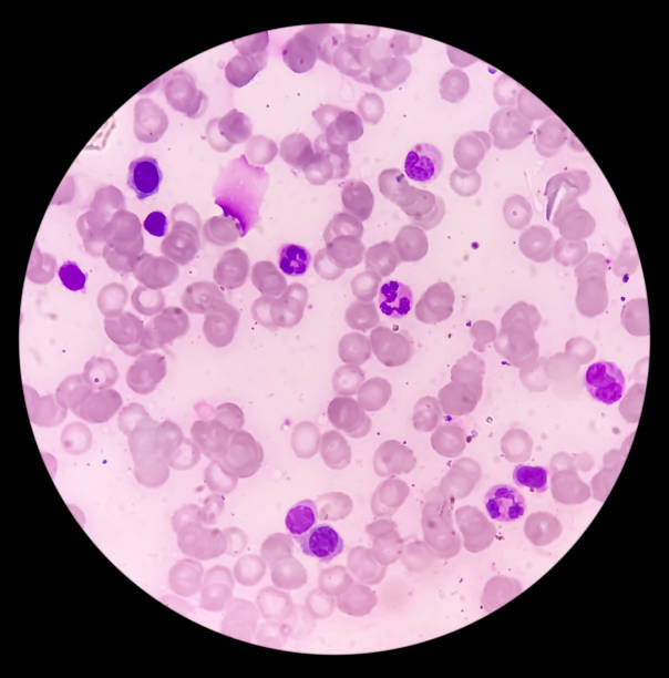 istock Bone marrow study (BMD). Myelodisplastic syndrome (MDS) or Refractory anemia. It's a group of cancers in which immature blood cells in the bone marrow. Myelodysplasia. 2111303603