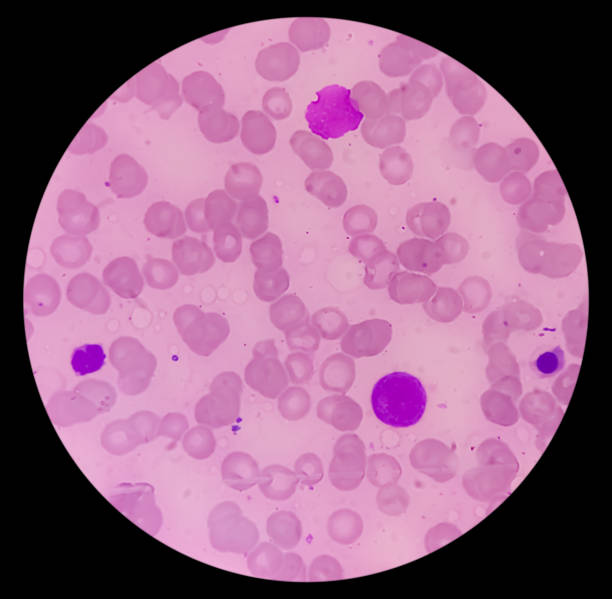istock Bone marrow study (BMD). Myelodisplastic syndrome (MDS) or Refractory anemia. It's a group of cancers in which immature blood cells in the bone marrow. Myelodysplasia. 2111304734