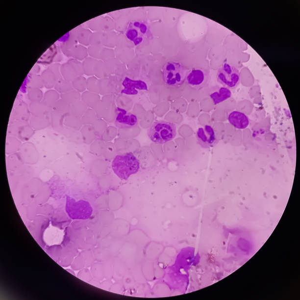 istock Bone marrow study (BMD). Myelodisplastic syndrome (MDS) or Refractory anemia. It's a group of cancers in which immature blood cells in the bone marrow. Myelodysplasia. 2111305338